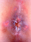 Multiple painful perianal lesions caused by HSV-2 infection.