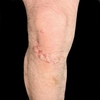 This photograph shows characteristic scaling, plaque-like lesions on the extensor surface of the knees.&nbsp;