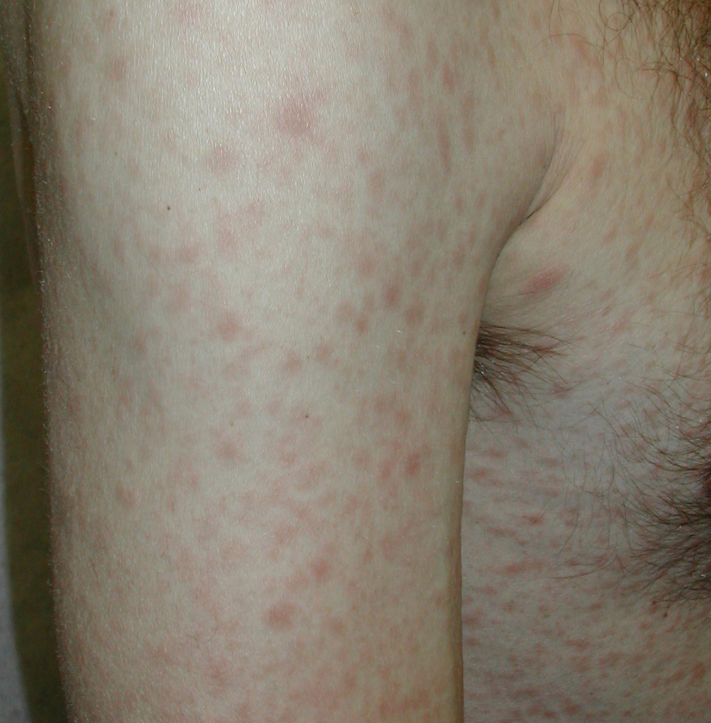 Std Skin Rash Types Std Skin Rash Types